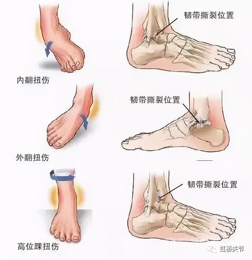 踝关节是哪个部位图片 踝关节在哪个部位图片